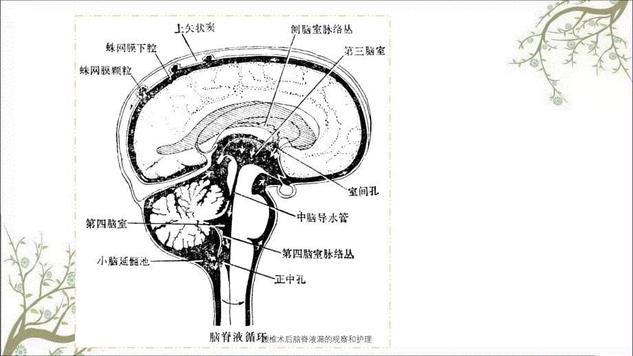 腰椎术后脑脊液漏的观察和护理_第5页