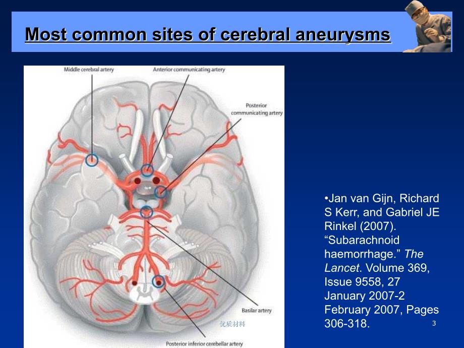 动脉瘤的影像诊断.优质借鉴_第3页
