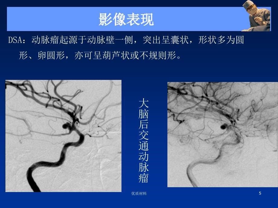 动脉瘤的影像诊断.优质借鉴_第5页