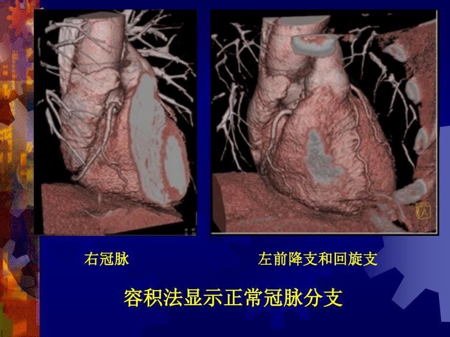 多排螺旋ct在冠脉的应ppt课件_第5页