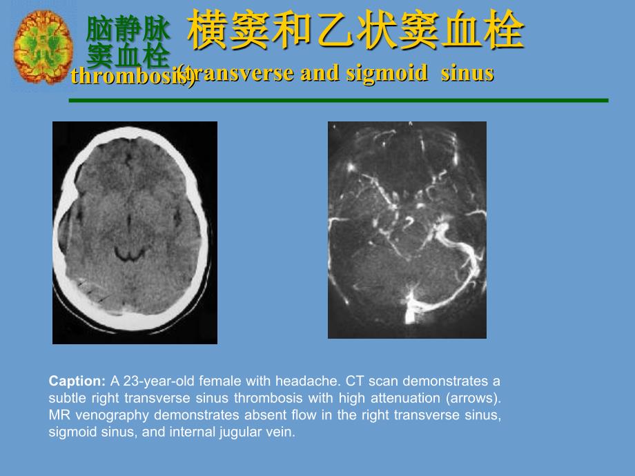 横窦和乙状窦血栓PPT课件_第3页