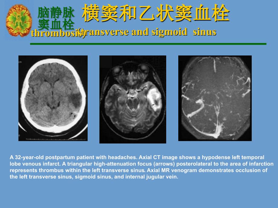 横窦和乙状窦血栓PPT课件_第4页