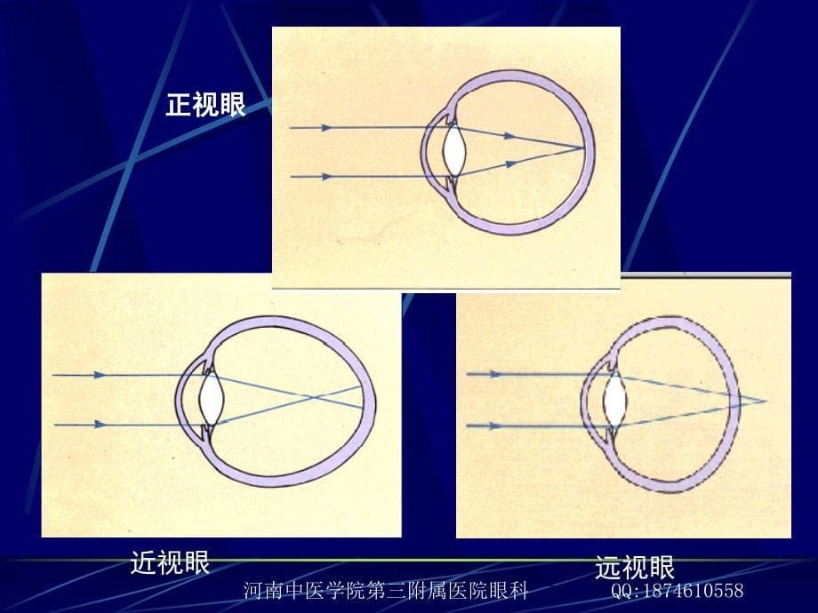 第四章 预防近视眼-冯磊_第5页
