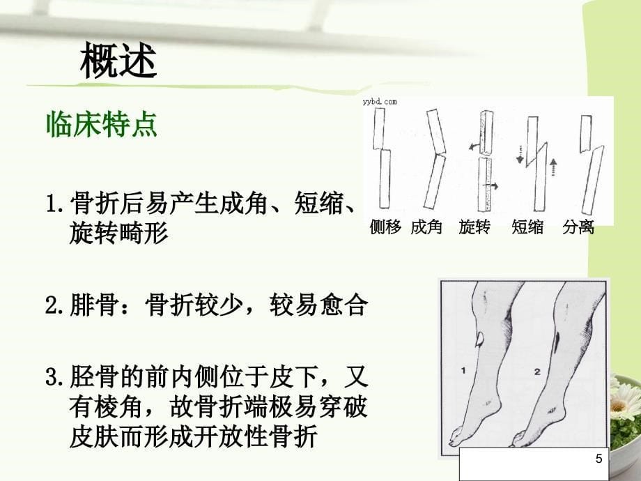 胫腓骨骨折手术配合及访视课件_第5页