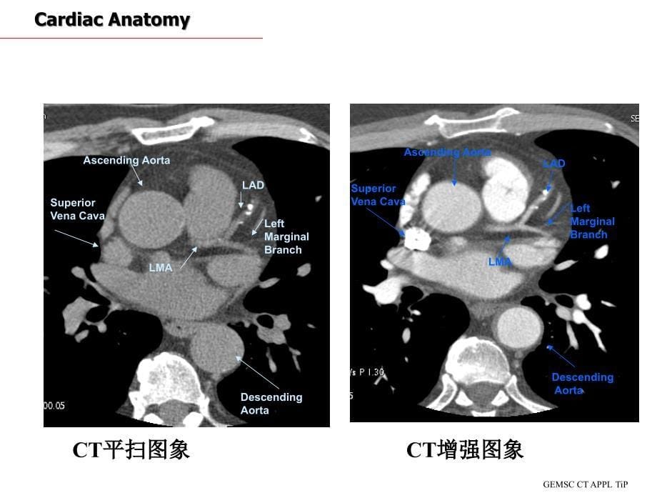 CT心脏断面解剖PPT课件_第5页