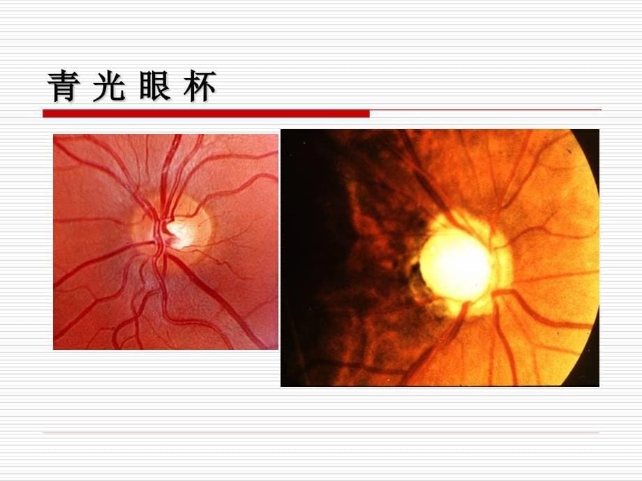 【医学超级全】青光眼-郑天生12.4.3_第5页