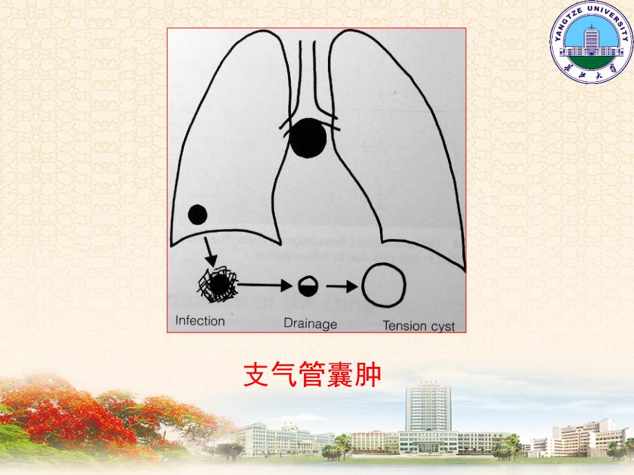 呼吸系统1影像pp课件_第4页