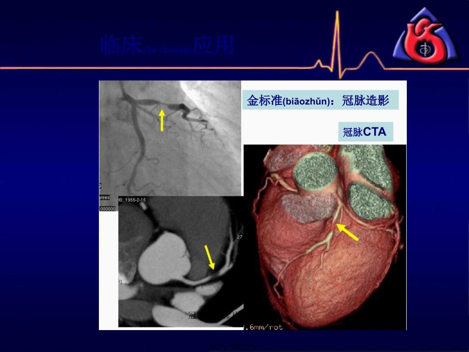 冠脉CTA读片非常课件_第2页