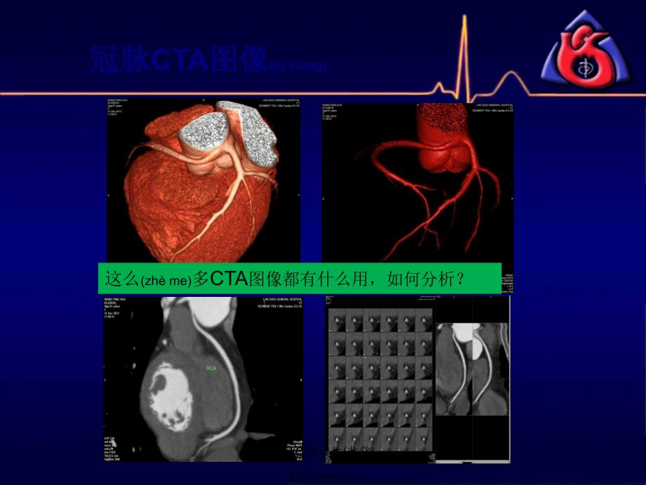 冠脉CTA读片非常课件_第3页