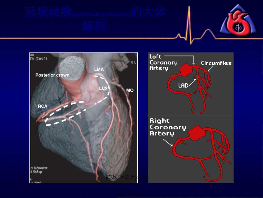 冠脉CTA读片非常课件_第4页