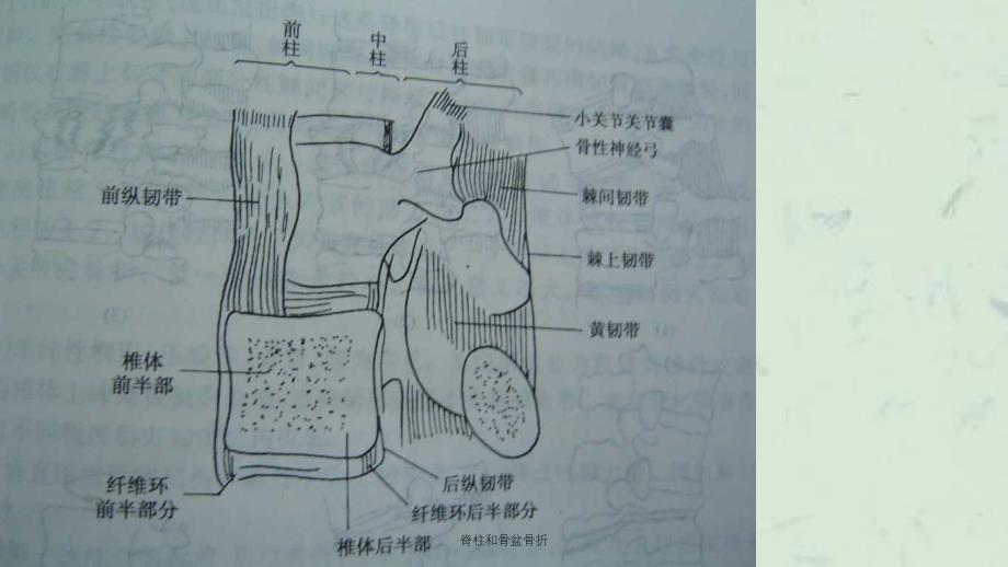 脊柱和骨盆骨折课件_第3页