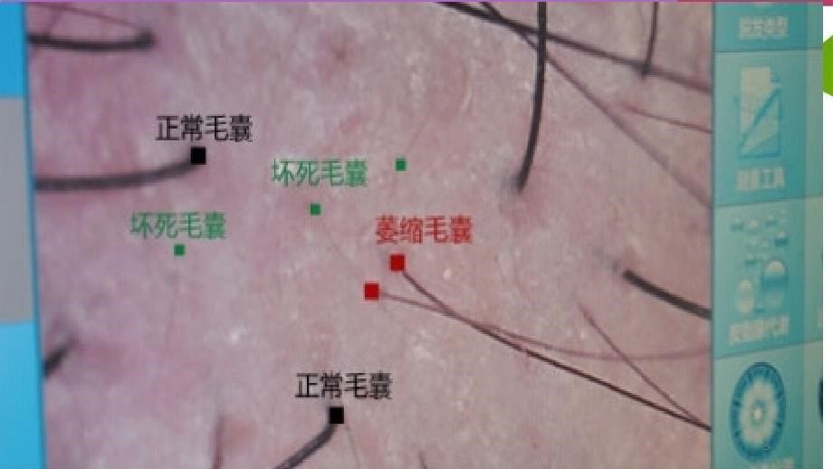 优质课件植发基础知识_第5页