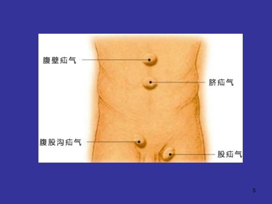 腹外疝科普优秀课件_第5页