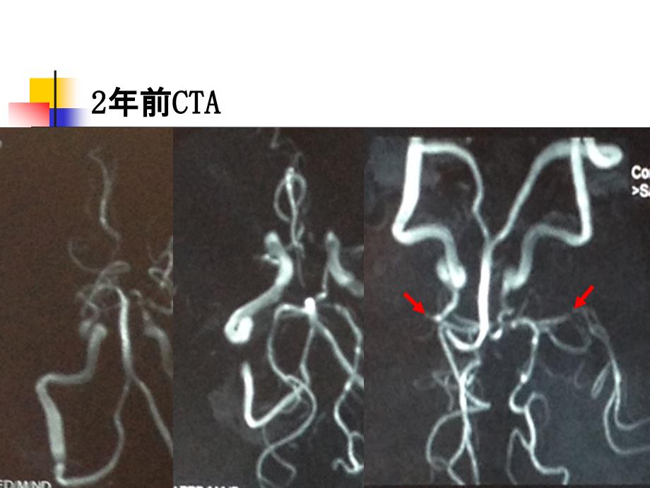 脑梗死病例ppt课件_第4页