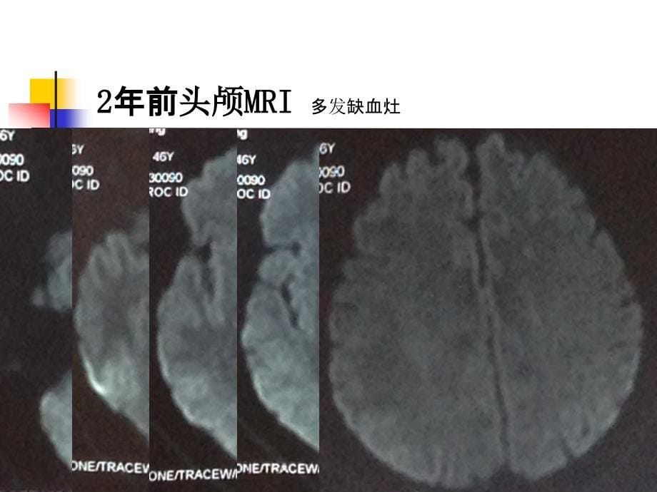 脑梗死病例ppt课件_第5页