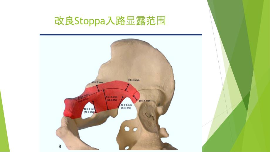 改良Stoppa入路解剖_第3页