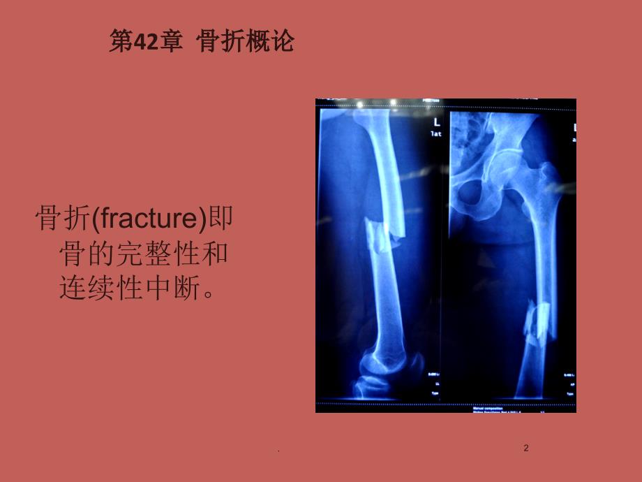 (医学课件)骨折概论 外科学ppt演示课件_第2页