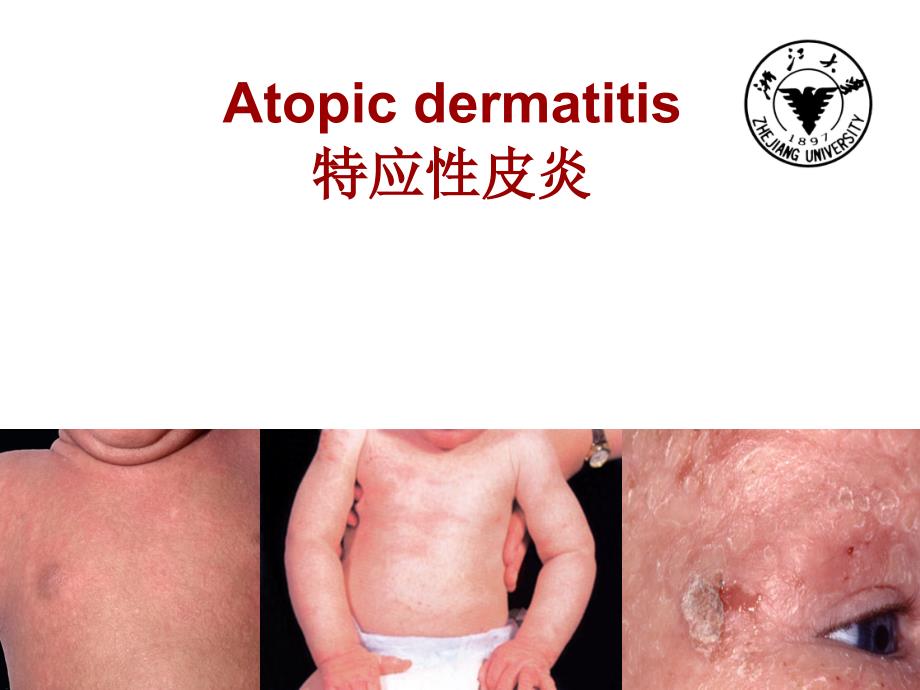 皮肤科学英语课件：Atopic Dermatitis_第1页