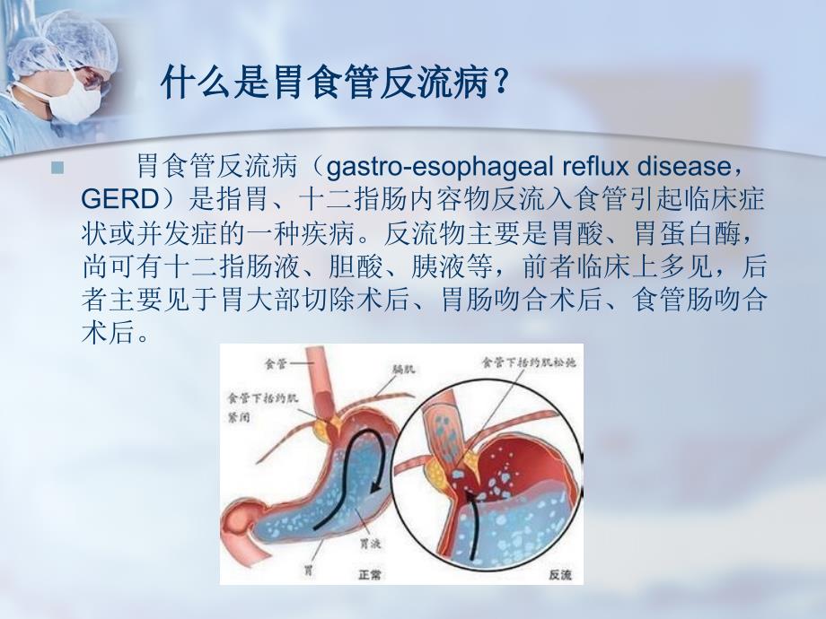 胃食管反流病健康教育.ppt_第2页