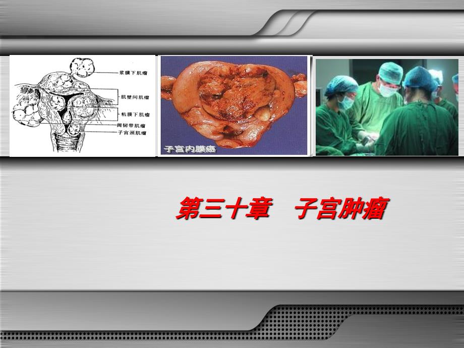 妇产科学第八版 子宫肿瘤 课件.ppt_第3页