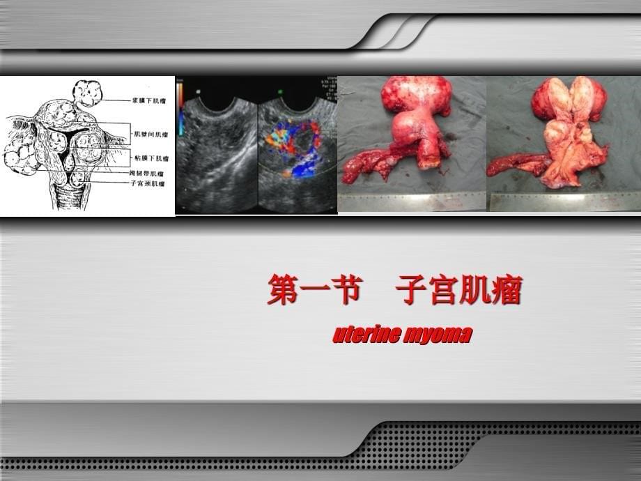 妇产科学第八版 子宫肿瘤 课件.ppt_第5页