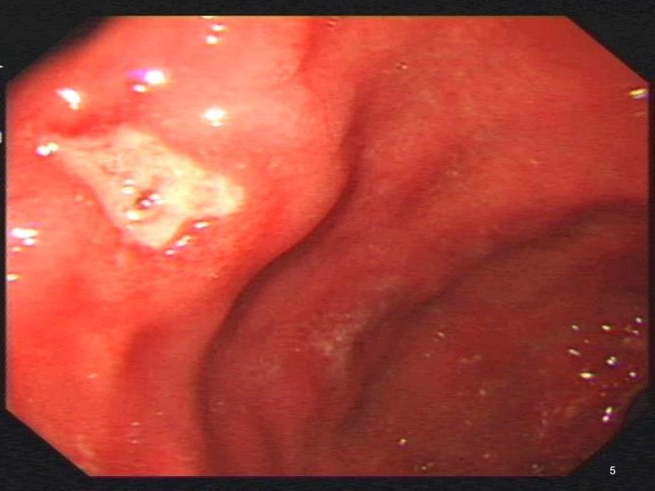 上消化道出血小讲课课堂PPT_第5页