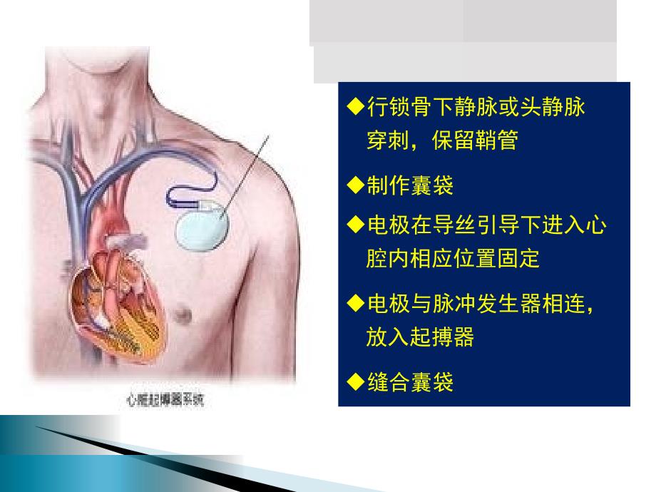 永久性人工起搏器植入术后囊袋并发症的预防和护理PP课件_第3页