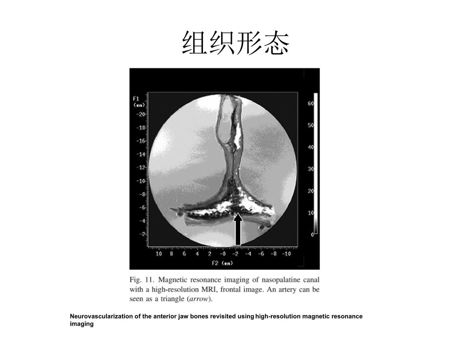 前牙种植鼻腭管_第4页