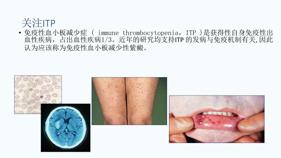 免疫性血小板减少性紫癜_第3页