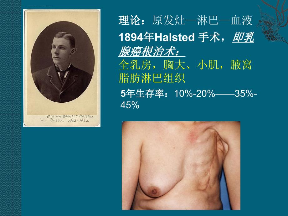 乳腺癌的手术治疗ppt课件_第3页