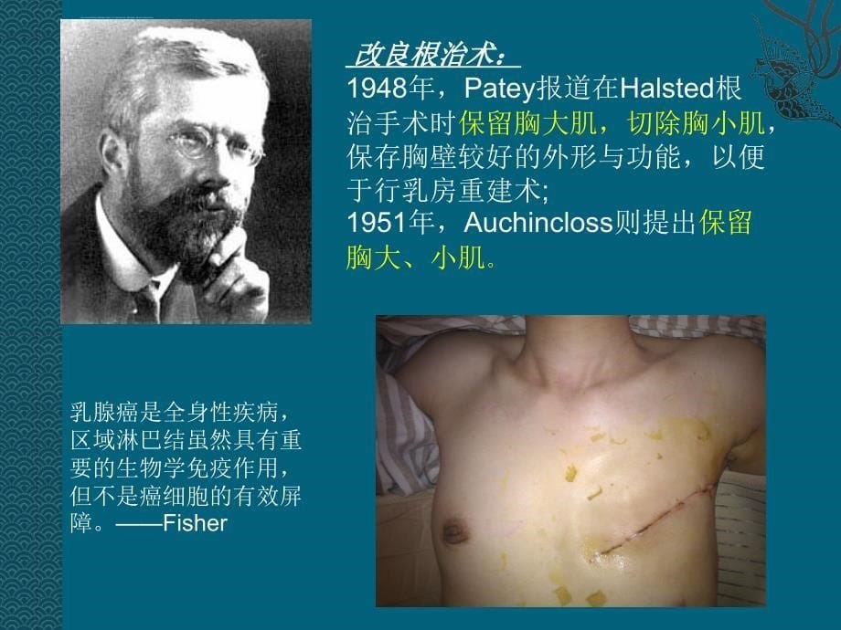 乳腺癌的手术治疗ppt课件_第5页