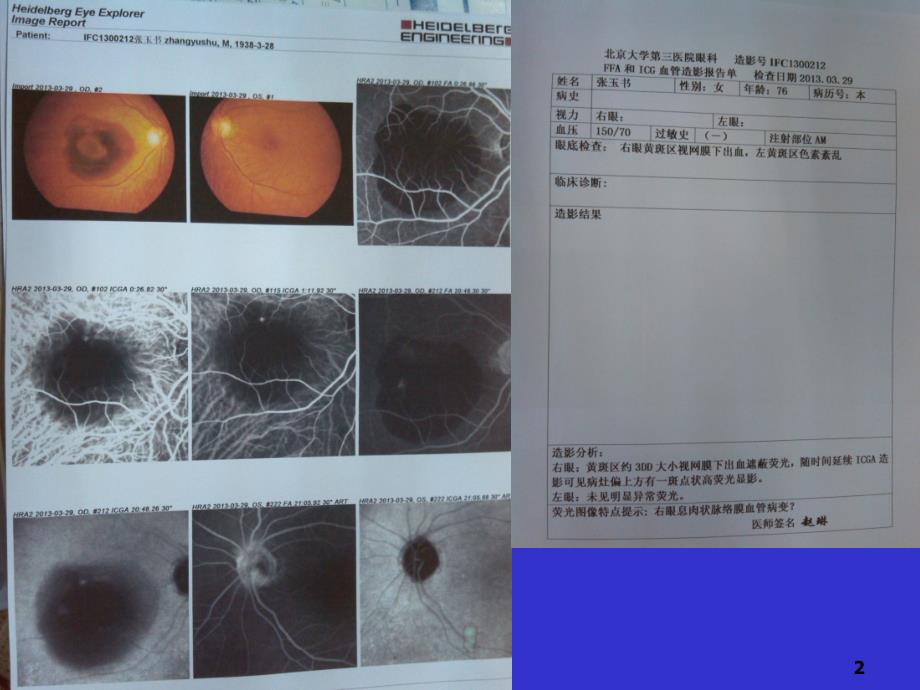 PCV诊断鉴别及其治疗2ppt课件_第2页