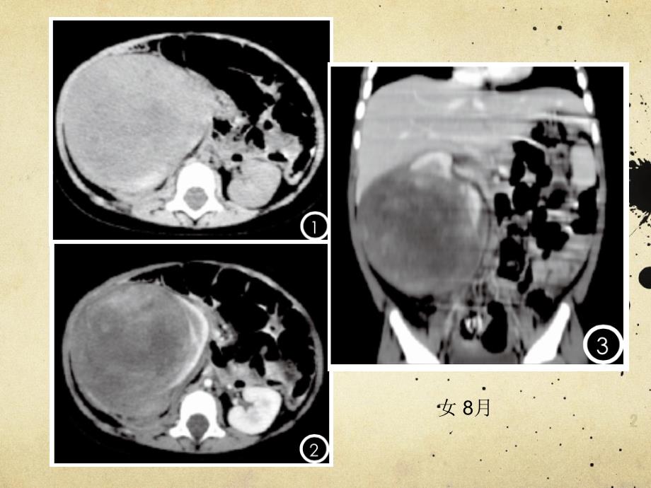 （优质课件）肾母细胞瘤_第2页