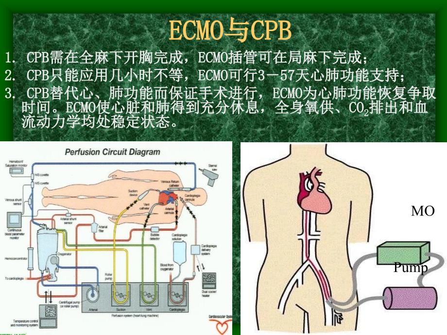 ECMO技术临床应用_第3页