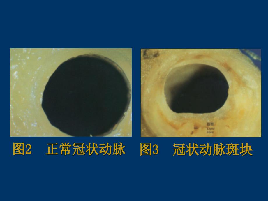 最新24抗动脉粥样硬化药精选PPT文档_第2页