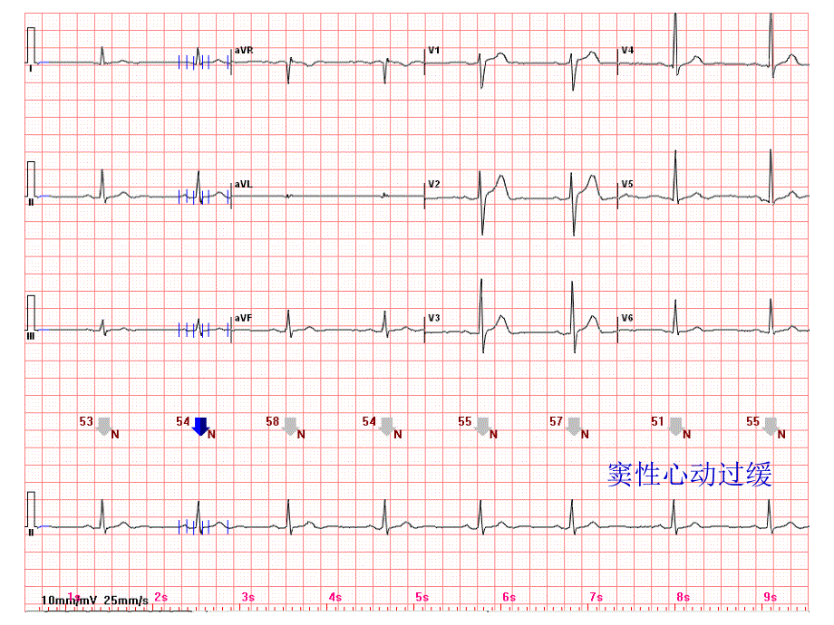 心电图常见正常和异常心电图图谱_第1页