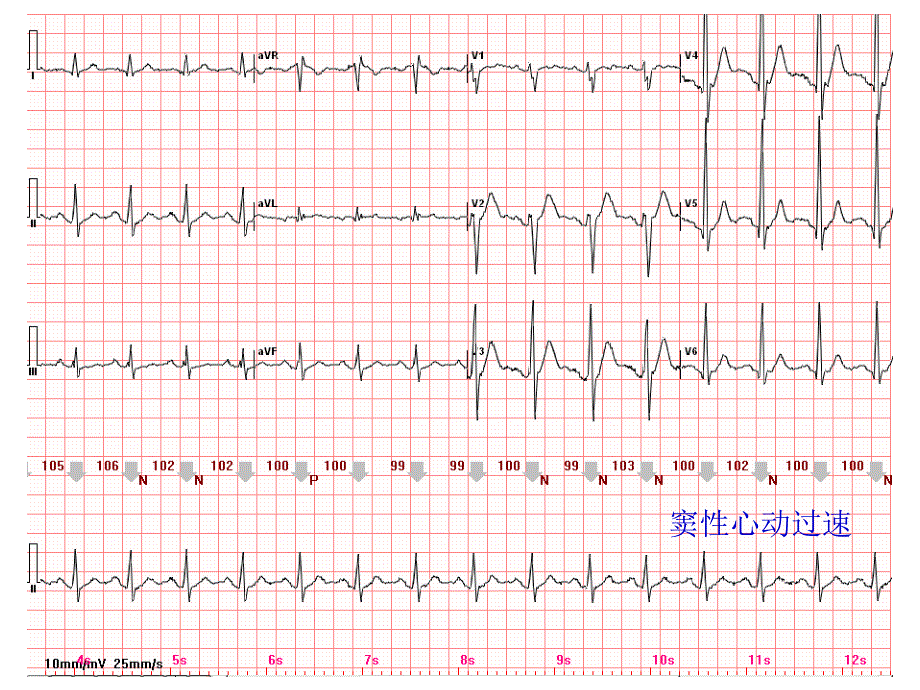 心电图常见正常和异常心电图图谱_第2页