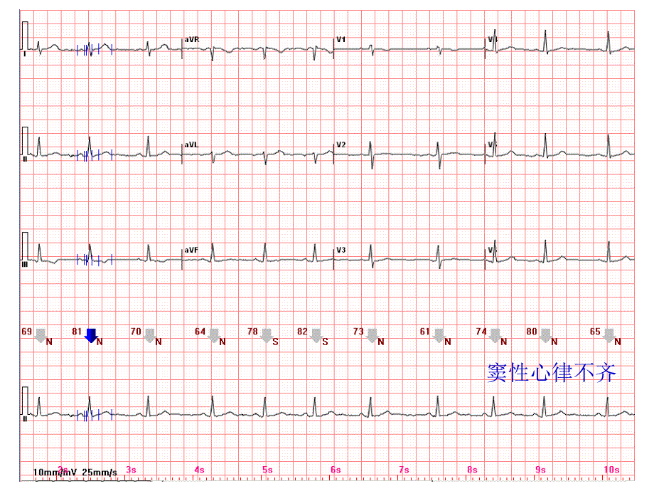 心电图常见正常和异常心电图图谱_第3页
