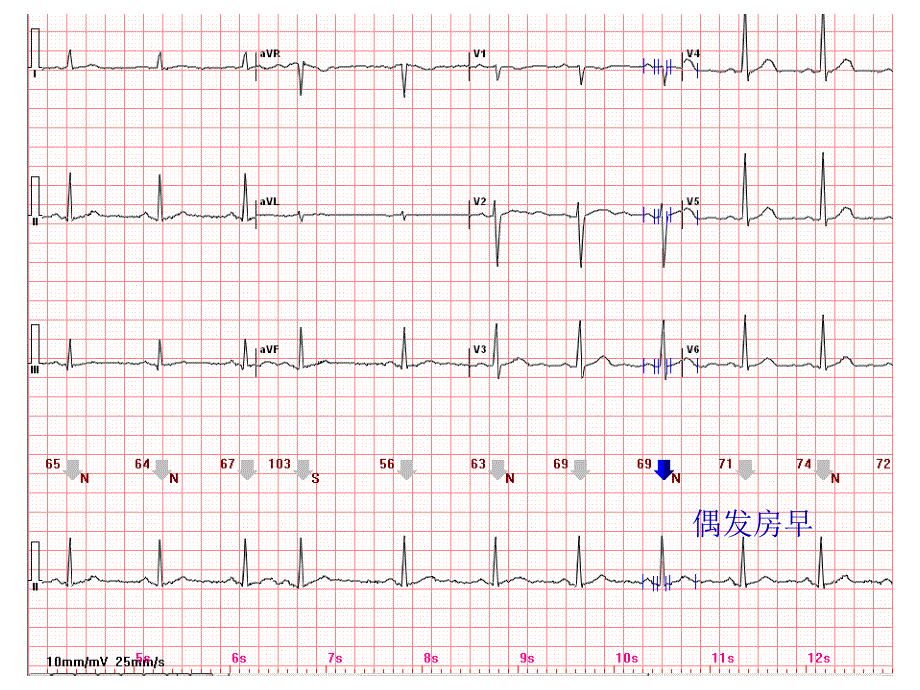 心电图常见正常和异常心电图图谱_第4页