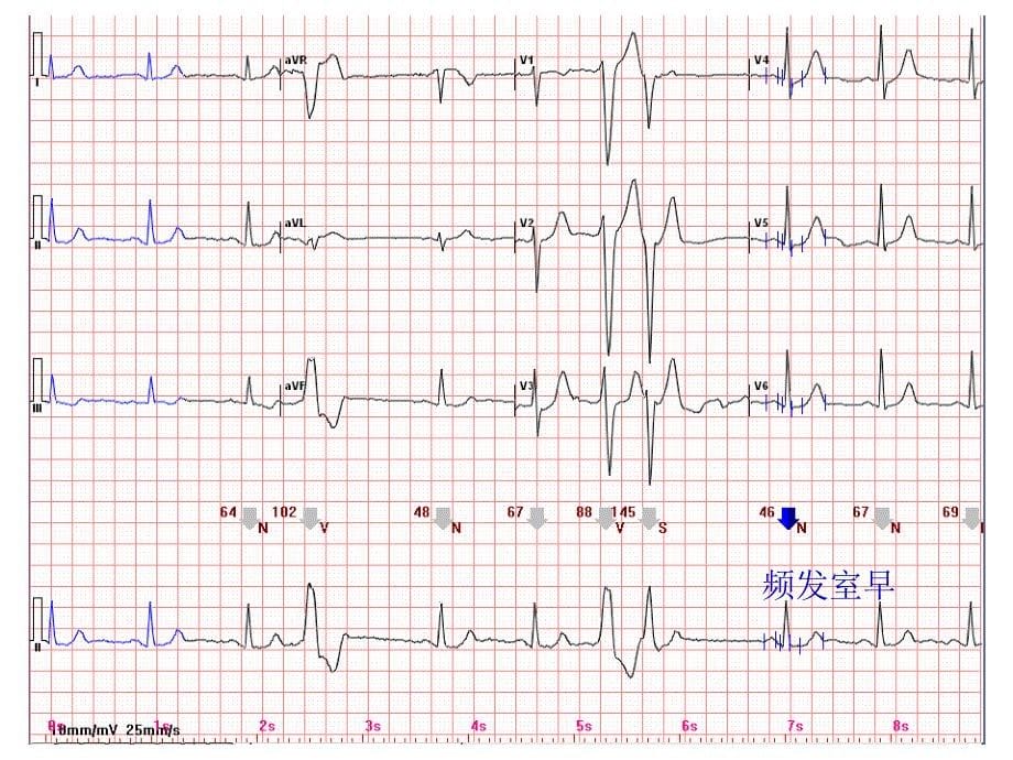心电图常见正常和异常心电图图谱_第5页