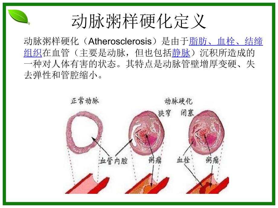 《动脉粥样硬化》PPT课件_第3页