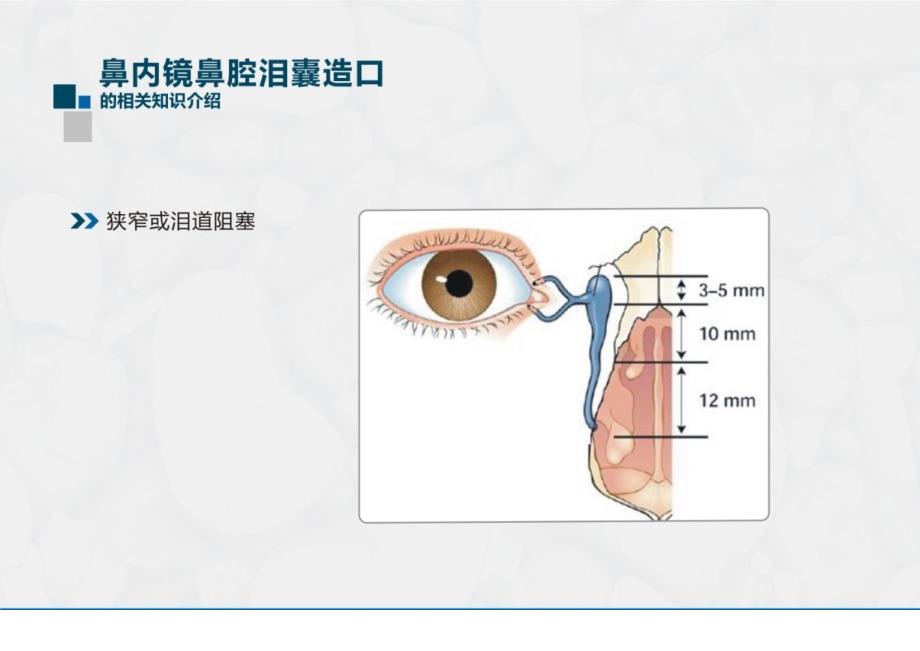 2145005211鼻内镜鼻腔泪囊造_第3页