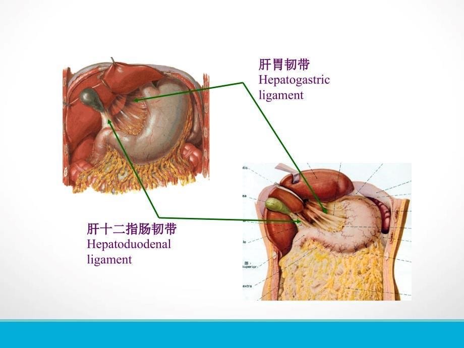 肝脏镰状韧带旁假病灶的CT表现课件.ppt_第5页