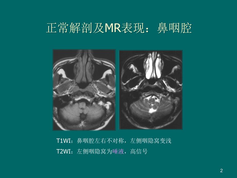 鼻咽癌MR诊断ppt课件_第2页