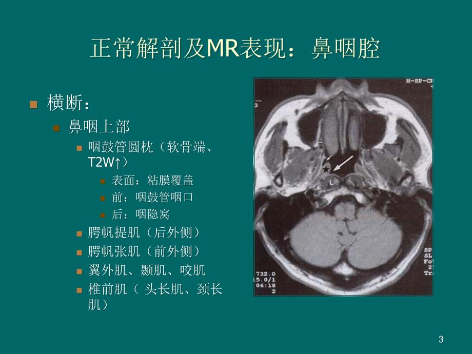 鼻咽癌MR诊断ppt课件_第3页