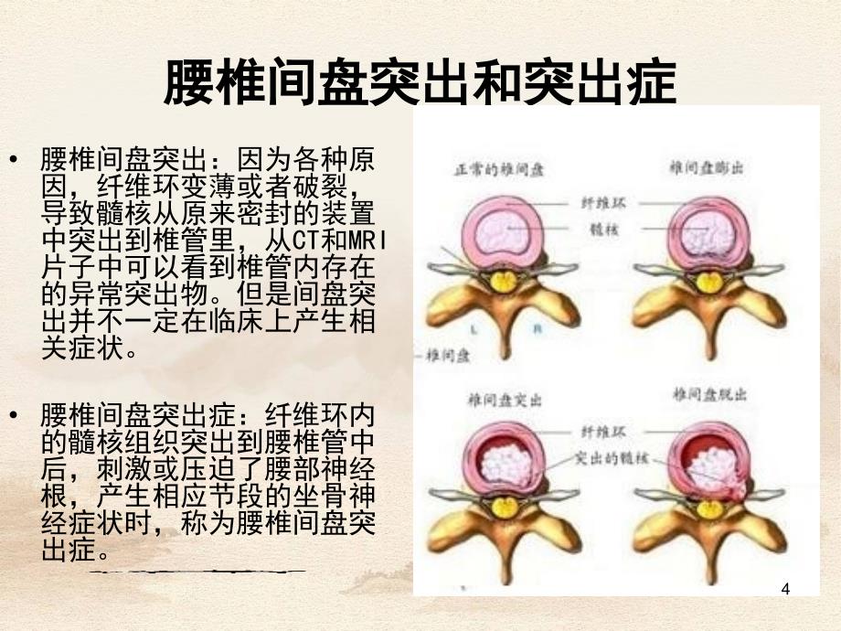 优质课件腰椎间盘突出症的康复治疗_第4页