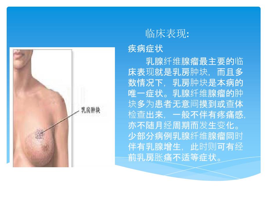 乳腺纤维腺瘤_第4页