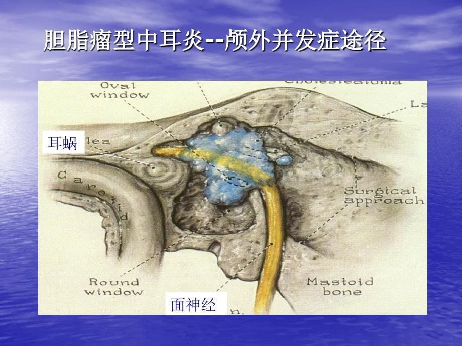 慢性化脓性中耳炎并发症_第5页