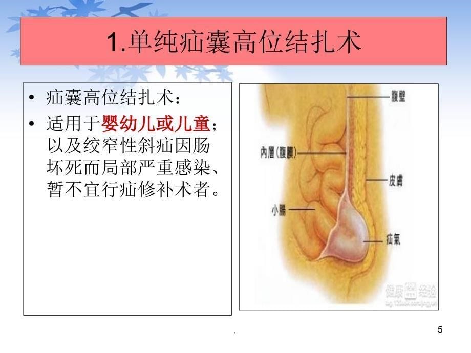 腹股沟疝手术ppt演示课件_第5页