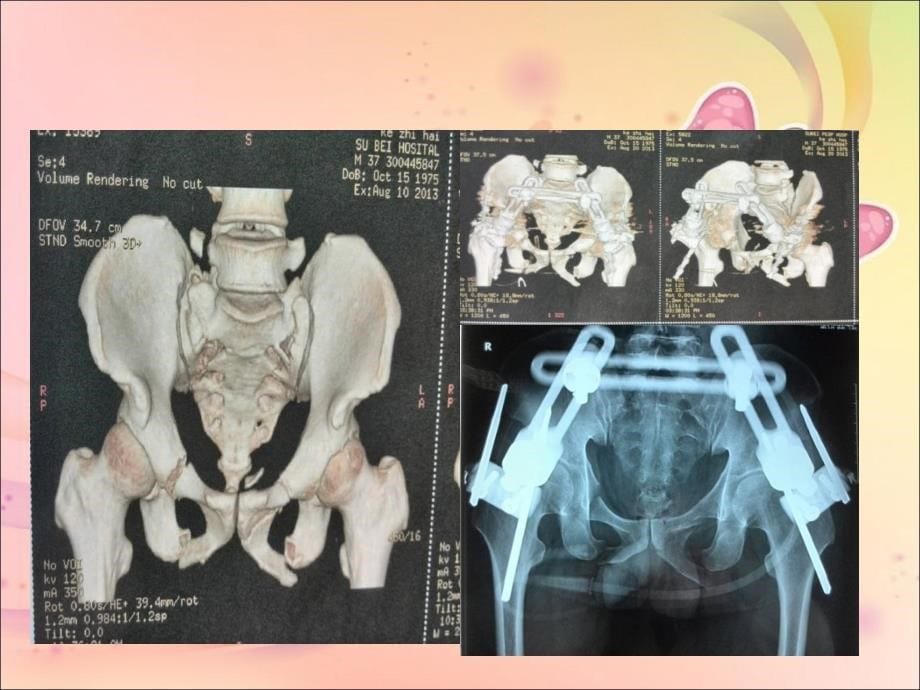 八月份骨盆骨折护理查房_第5页